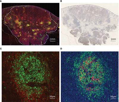 Tertiary Lymphoid Structures and Chemokine Landscape in Virus-Positive and Virus-Negative Merkel Cell Carcinoma